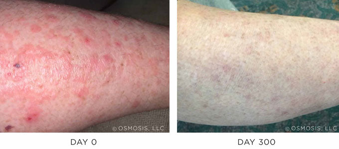 Before and After Results Showing Improvement in Vascular Dermatitis