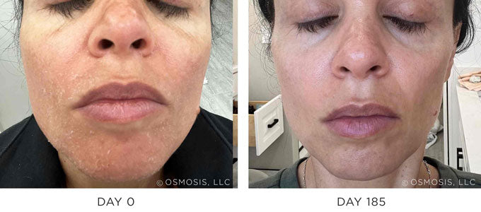 Before & After Results Showing Improvement in Dry Skin