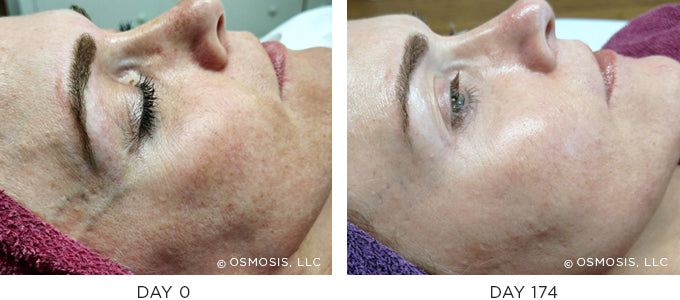 Before and After photo showing improvement in pigmentation and uneven skin tone