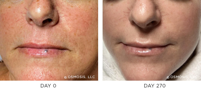Before and After Photos - Pigmentation, Aging, and Post-Cancer Skin