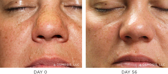 Before and After photo showing improvement in pigmentation and uneven skin tone