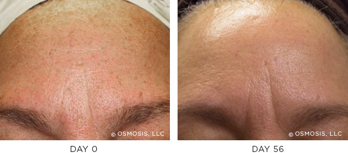 Before and After photo showing improvement in pigmentation and uneven skin tone