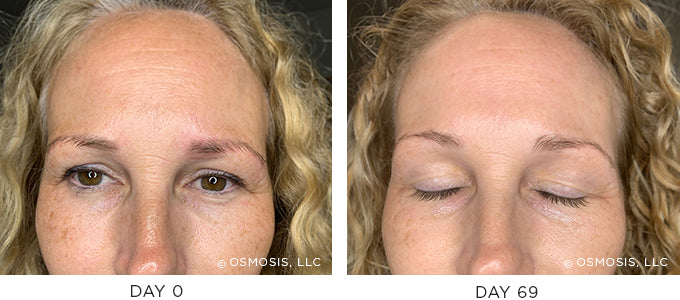 Before and After of Age Spot Pigmentation Improvement