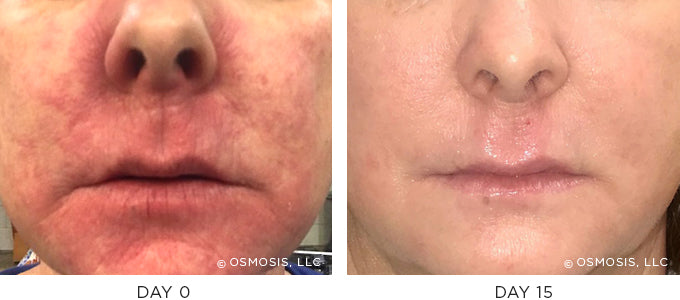 Before and After photo showing improvement in redness and irritation