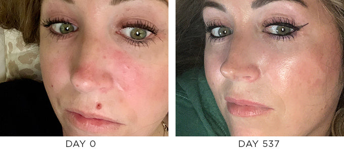 Before and After Results showing improvement in Rosacea