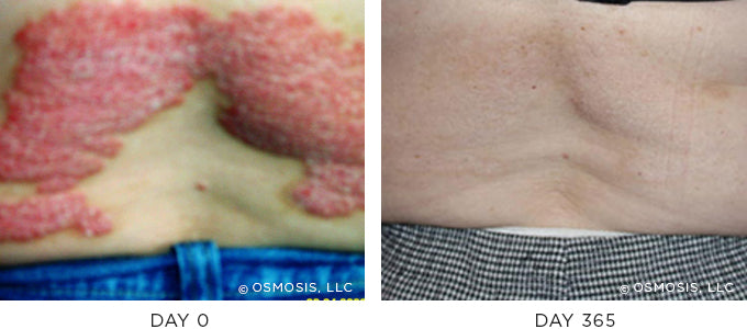 Eczema Psoriasis Before and After – Osmosis Beauty