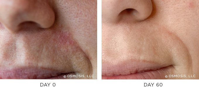 Before and After photo showing improvement in redness and irritation