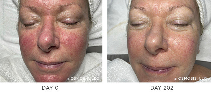 Before & After Results showing improvement in aging skin, sensitive skin and rosacea