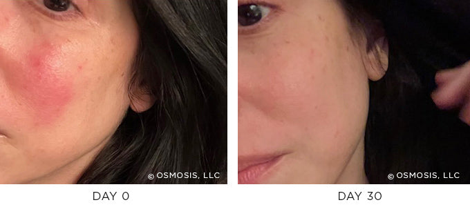 Before and After Images showing improvement in redness, dry patches, and skin tone