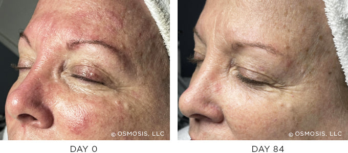 Before and After Photos - Aging skin, sensitive skin, dilated capillaries  