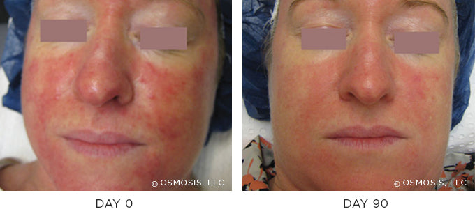 Before and After photo showing improvement in redness and irritation