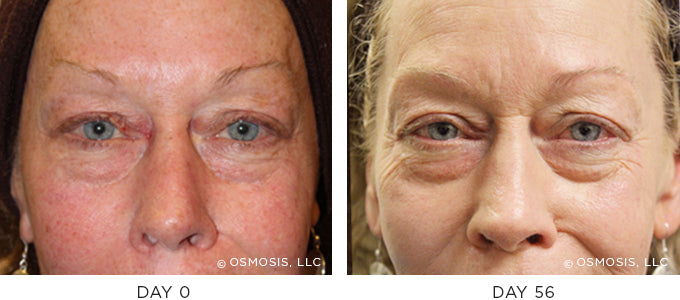 Before and After photo showing improvement in redness and irritation