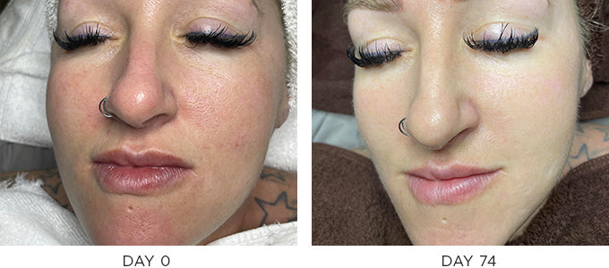Scarring Before and After Results - Texture