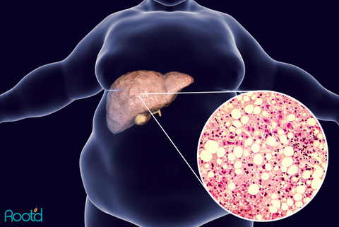 Sugar increases fat production in the liver