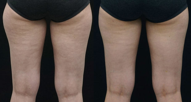 Clatuu Alpha before & after photo thighs