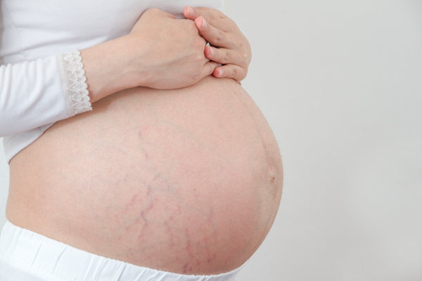 Stretch Marks Md Wellness Solutions