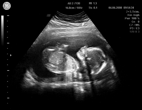 an ultrasound