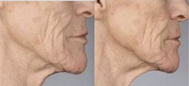 MAX™ stem cell neck lift