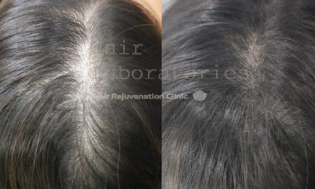 15 Best Hair Loss Treatments in Singapore For All Your Hair Woes 10