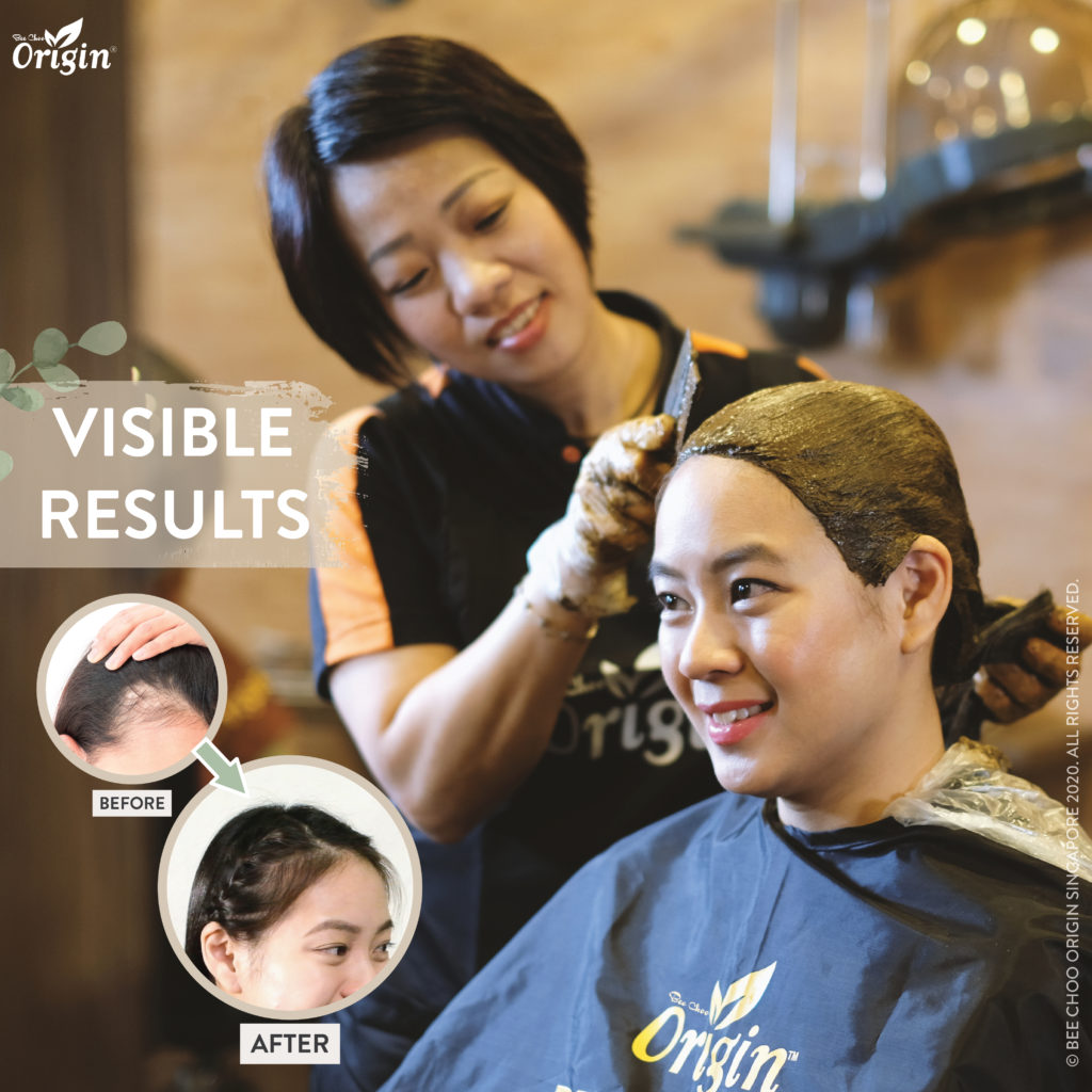 15 Best Hair Loss Treatments in Singapore For All Your Hair Woes 5