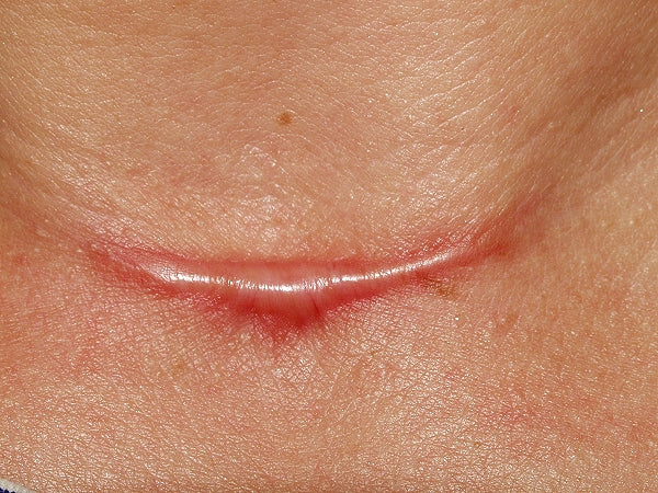 Cicatriz Hipertrófica