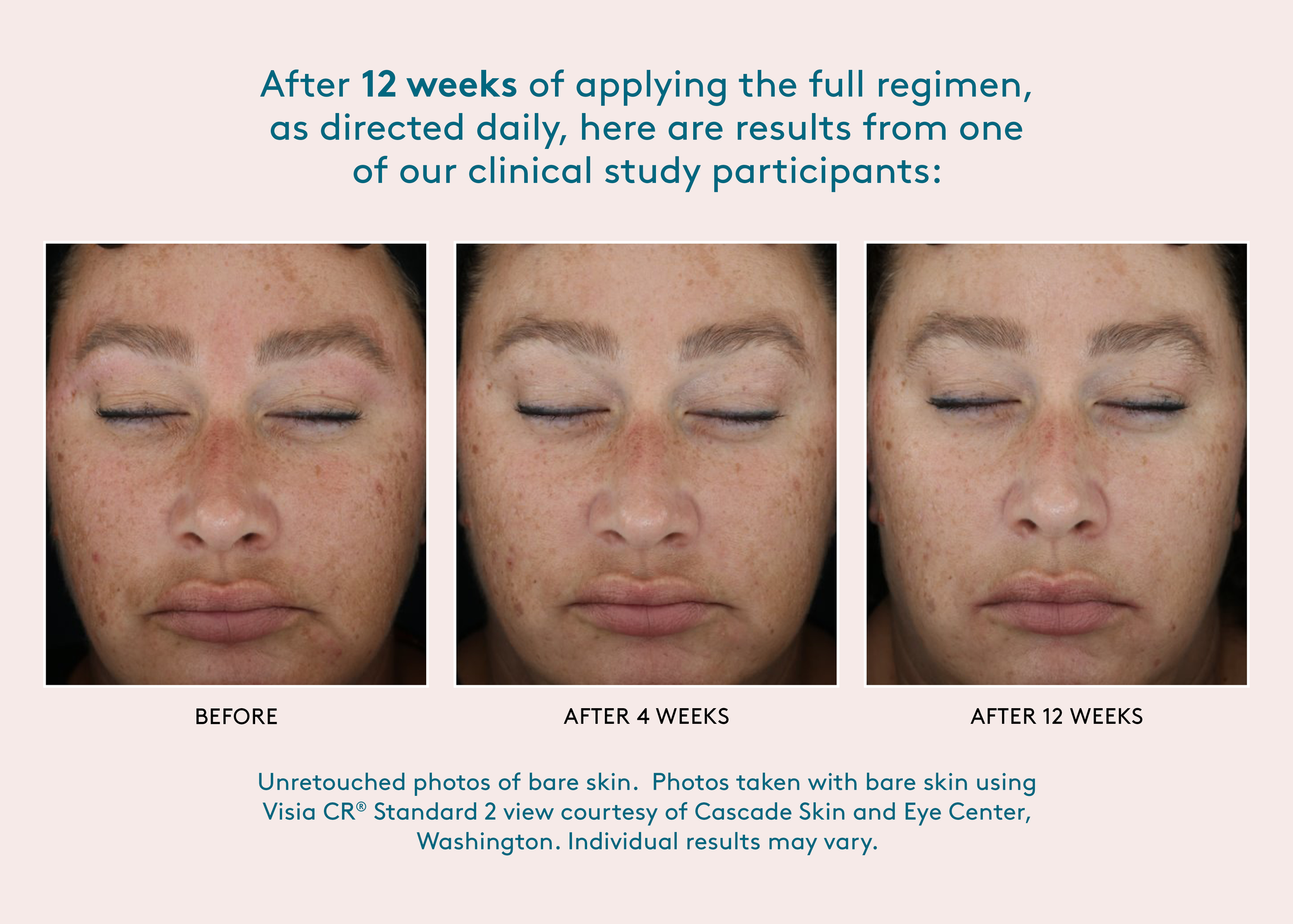 after twelve weeks of applying the full regimen, as directed daily, here some results from a clinical study participant