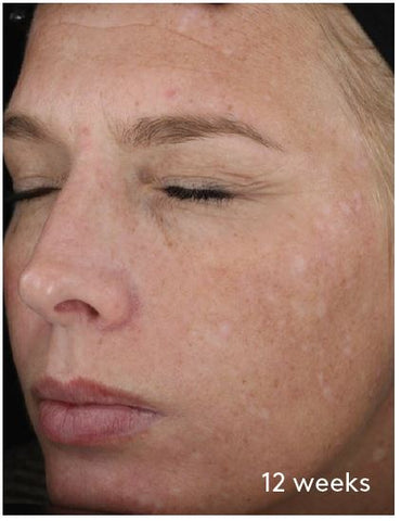 woman's face with reduced hyperpigmentation - 12 weeks