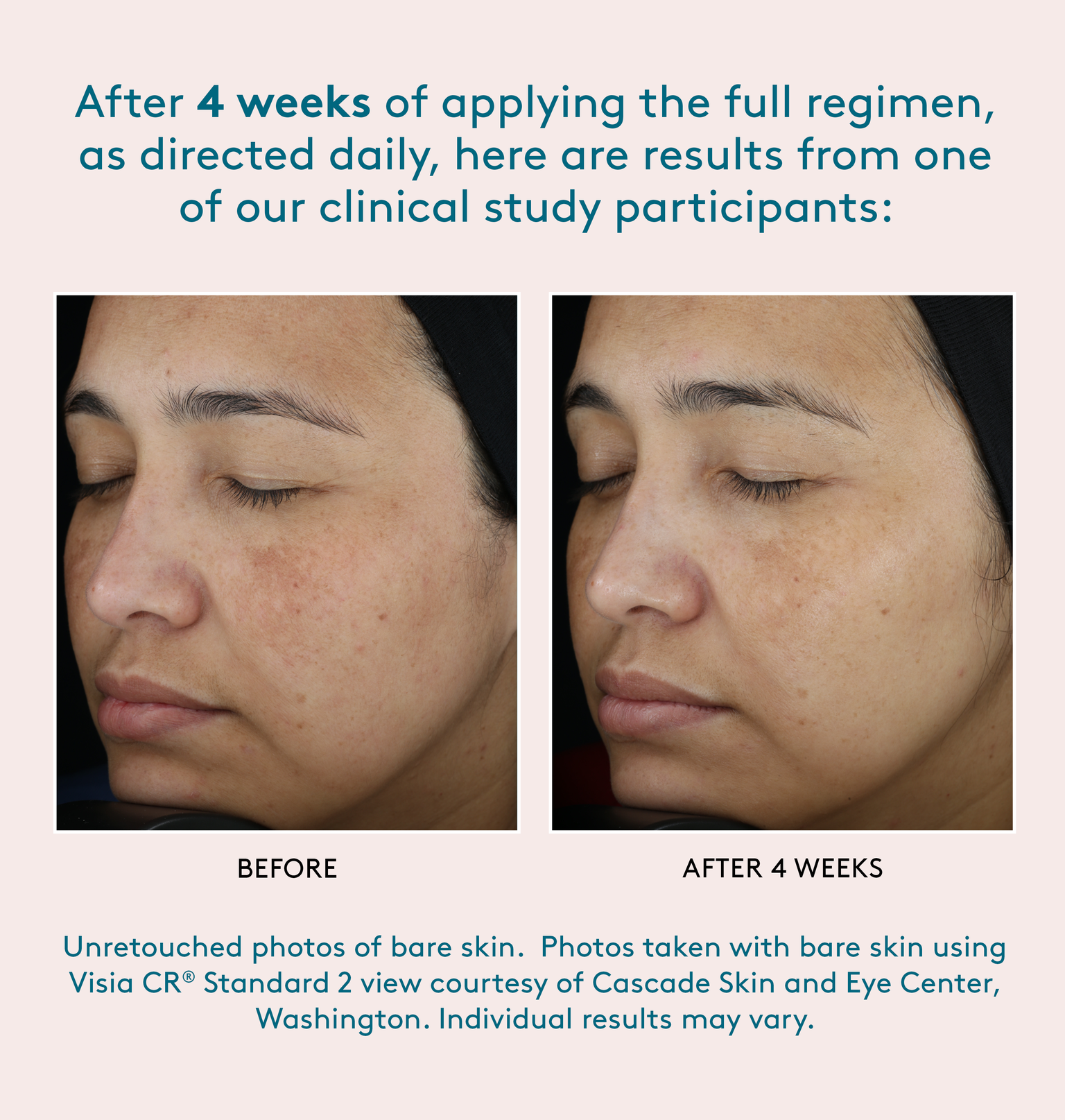 after four weeks of applying the full regimen, as directed daily, here some results from a clinical study participant