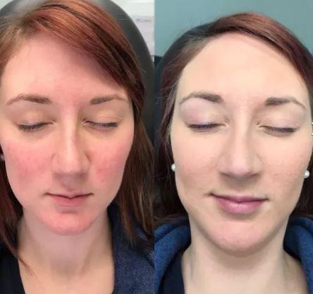 before after colorescience all calm