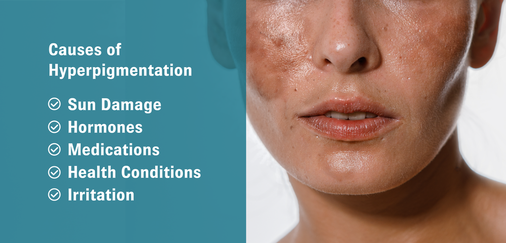 Graphic with an image of a close-up of a person’s face with hyperpigmentation on the right and text on the left side that reads, “Causes of Hyperpigmentation: Sun Damage; Hormones; Medications; Health Conditions; Irritation”.