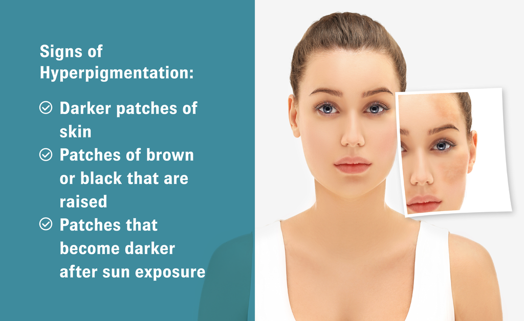 Graphic with an image of a woman with a pop-out close up of hyperpigmentation and text on the left that reads, ”Signs of Hyperpigmentation: Darker patches of skin; Patches of brown or black that are raised; Patches that become darker after sun exposure”.