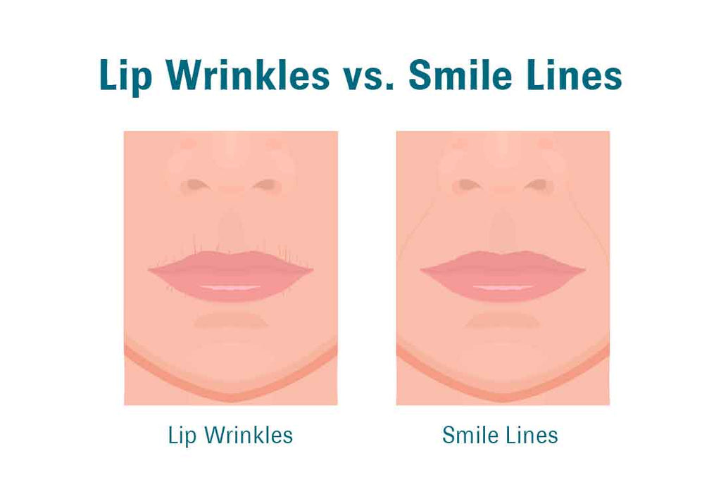 Graphic showing a visual comparison of lip wrinkles vs. smile lines.