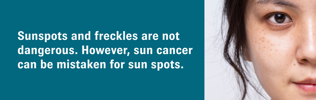 Sunspots and freckles are not dangerous.