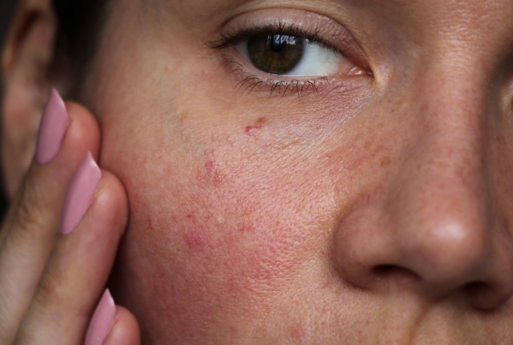 Woman touching her cheek with broken capillaries.