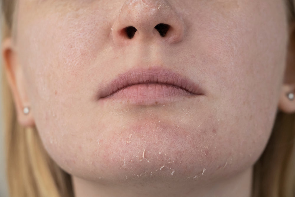 Close-up of woman with dry, peeling skin on her chin.