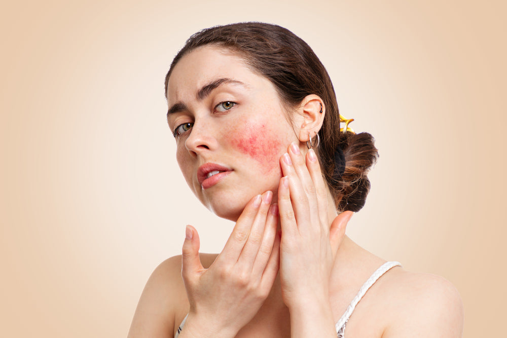 Woman touching face with rosacea on her cheek.