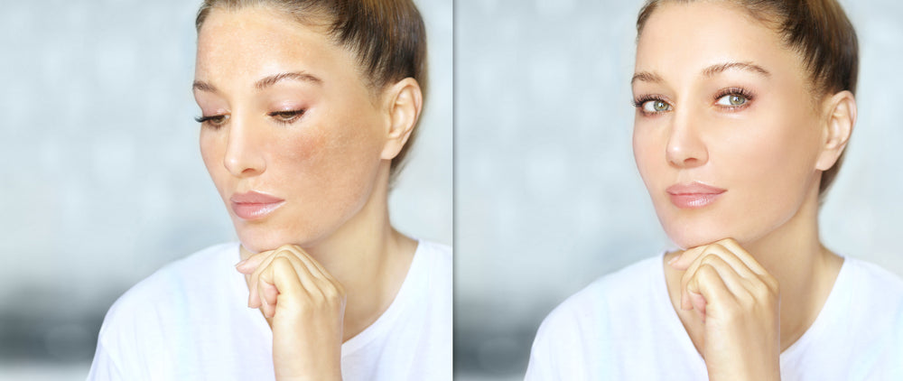 Before and after image of a white woman with hyperpigmentation and after treatment.