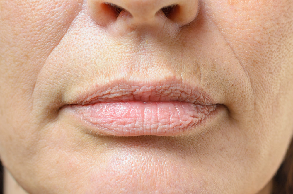 Close-up of a woman’s lips showing lip lines in the skin.