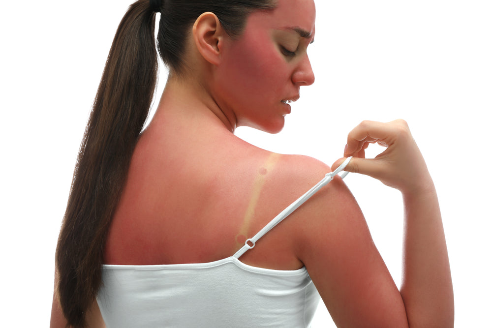 Sunburned brunette woman in a white tank top pulling down her strap to reveal a tan line.