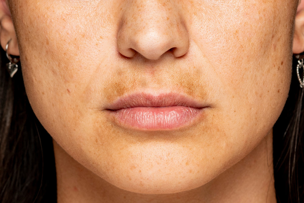 Uneven skin tone and spots showing on face