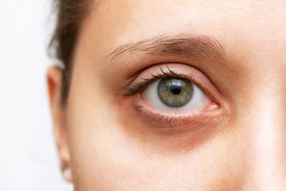 Close-up image of a woman’s eye, showing dark circles.