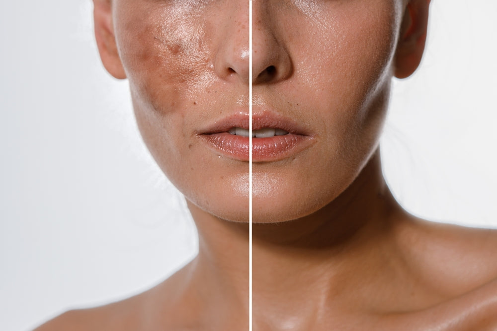 Split image showing a woman’s skin with and without melasma discoloration.