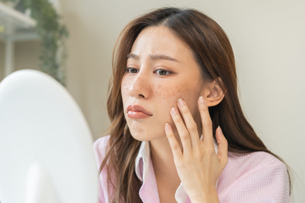 Asian woman looking at her skin with melasma in the mirror.