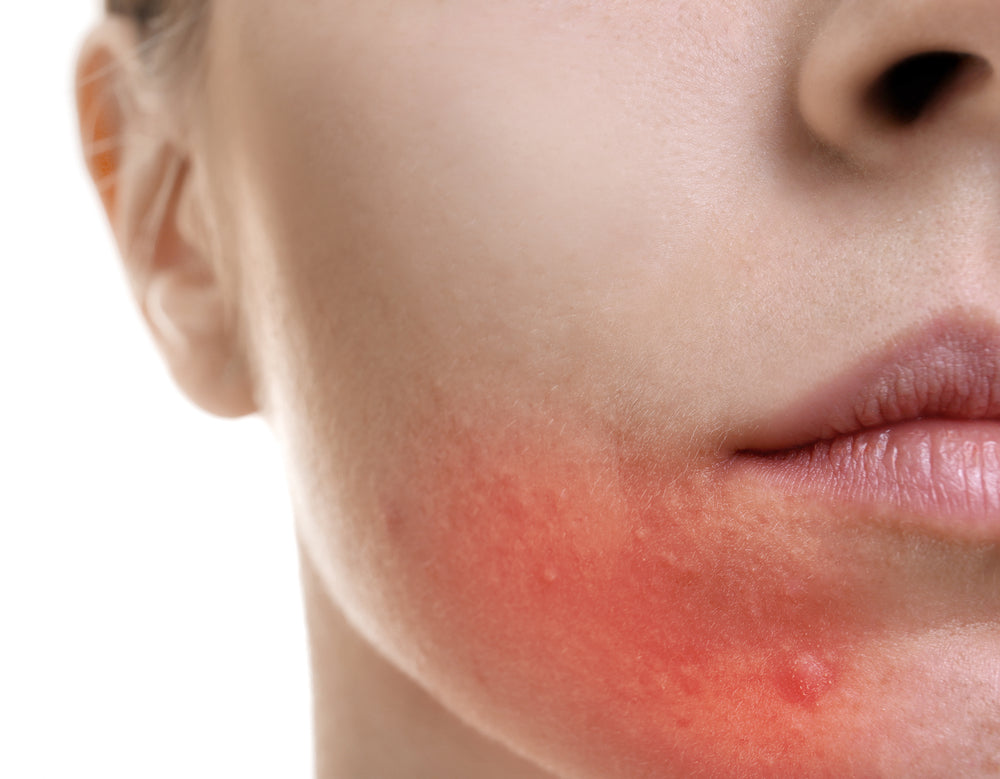 Signs of sensitive skin redness on face