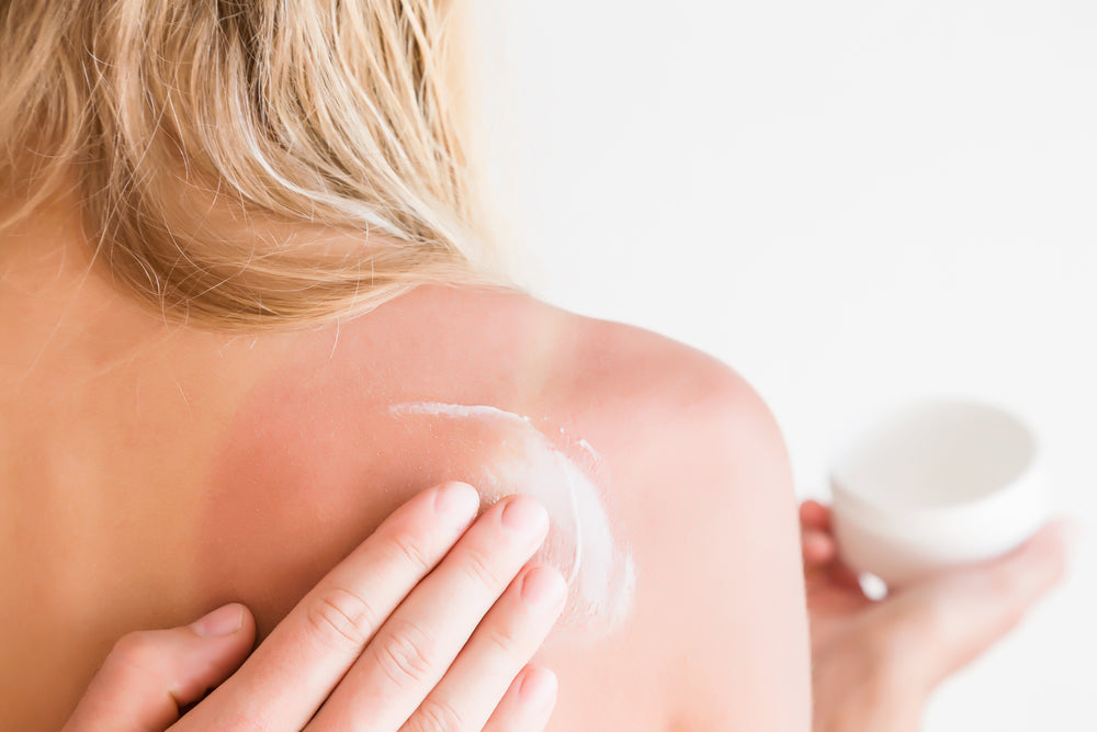 Young woman with a sunburn on her shoulders holding a container of cream while someone applies it to the burned area.