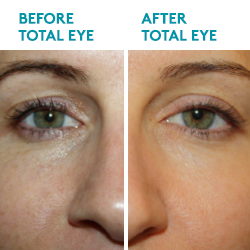 Total Eye® 3-in-1 Renewal Therapy SPF 35