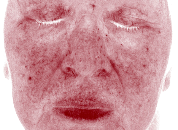 clinical study subject face scan - week 12, bare skin