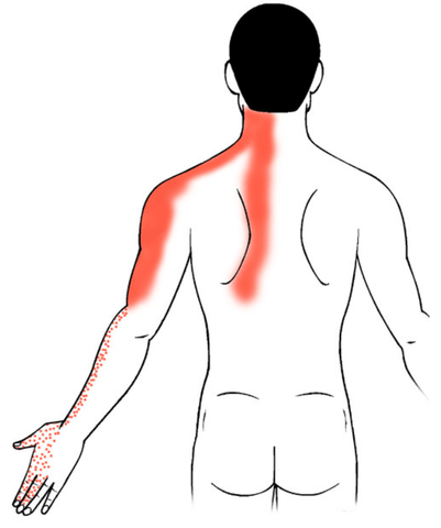 Graphic showing the pain areas from the shoulder to the arms and hands.