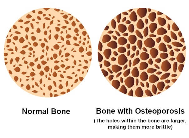 Image of a bone with and without osteoporosis.