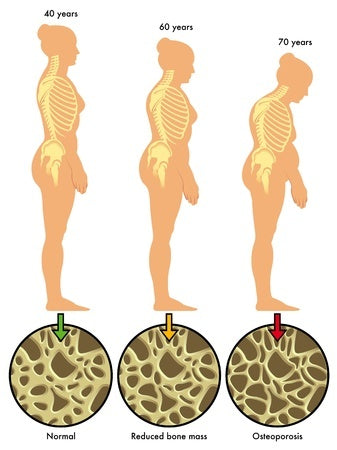 Image showing how osteoporosis can affect a person as he or she gets older.